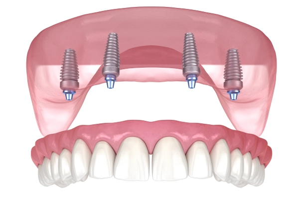 Process For Getting Snap-On Dentures_