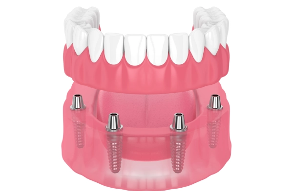 Snap-on Dentures at Margate & Pompano Beach,FL
