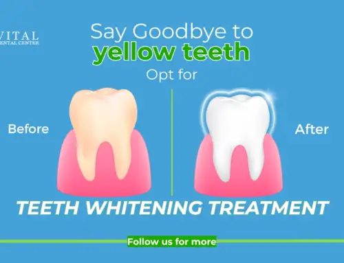 Say Goodbye to yellow teeth at Vital Dental Center