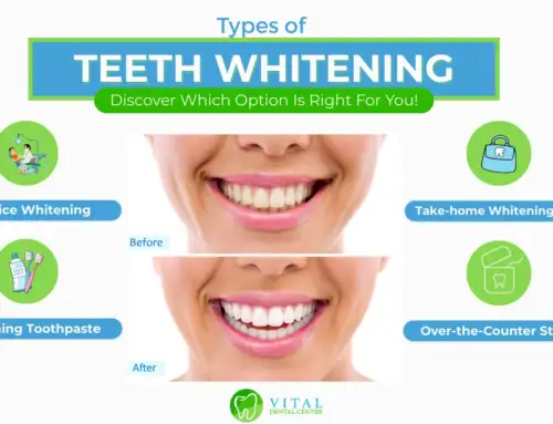 Types of Teeth Whitening in Pompano Beach, FL and Margate, FL